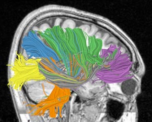 Computer image of brain