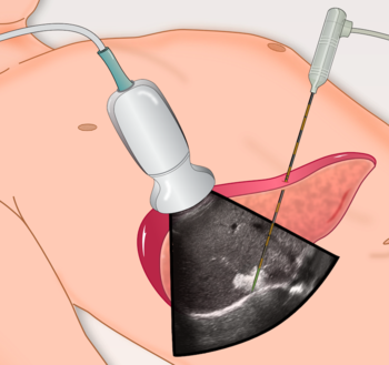 Illustration: tumor ablation procedure