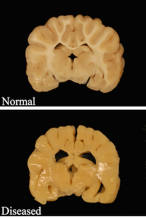 Photo: Dog brains with and without Pelizaeus Merzbacher disease modeling